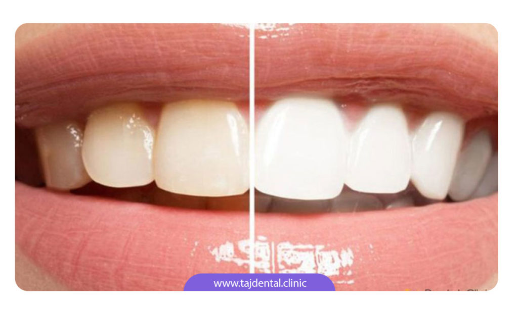 عکس قبل و بعد از بلیچینگ دندان در مطب