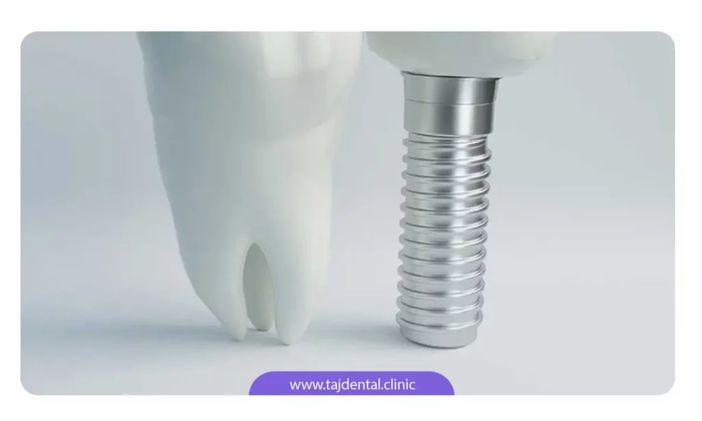 تصویر یک پایه ایمپلنت دندان در کنار دندان واقعی