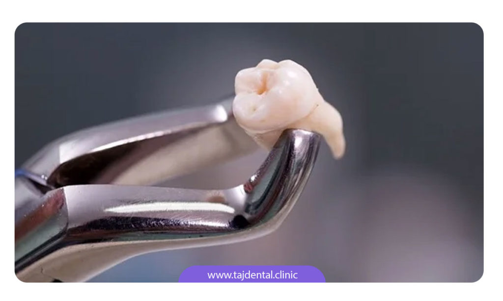 تصویر دندان کشیده شده با فورسپس
