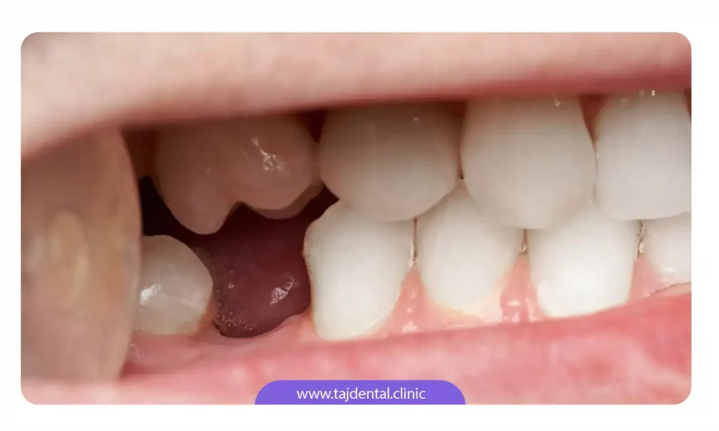 عکس جای خالی دندان کشیده شده که قرار است با ایمپلنت دندان جایگزین شود