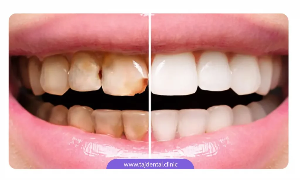 عکس قبل و بعد ترمیم دندان قدامی با ونیر کامپوزیت دندان