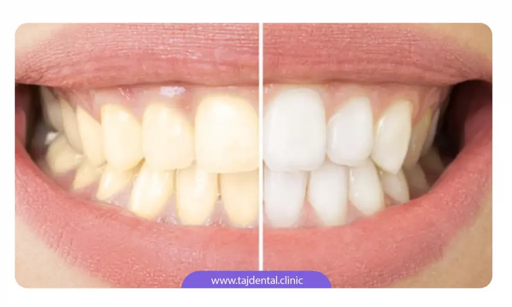 بلیچینگ دندان برای اصلاح طرح لبخند