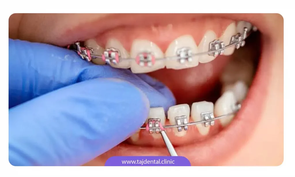 متخصص ارتودنسی در حال انجام تنظیمات وسایل ارتودنسی ثابت روی دندان بیمار