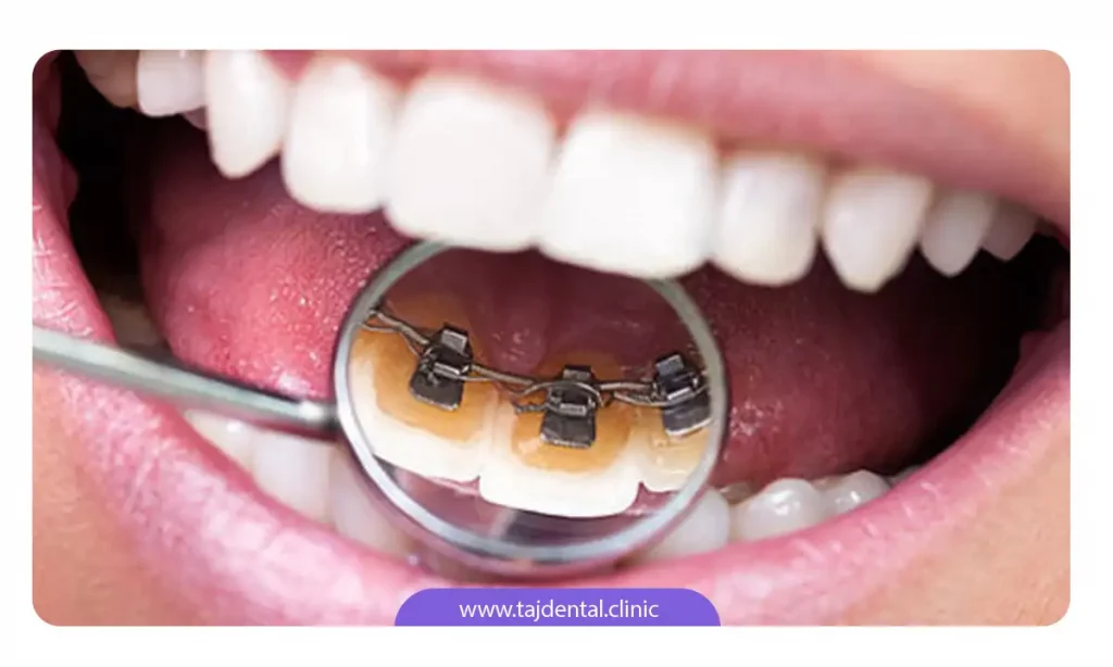 عکس سیم و براکت ارتودنسی لینگوال