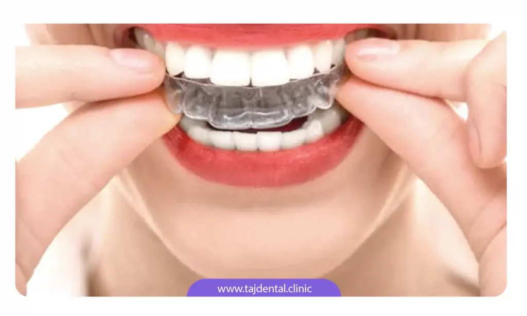عکس قالب ارتودنسی متحرک
