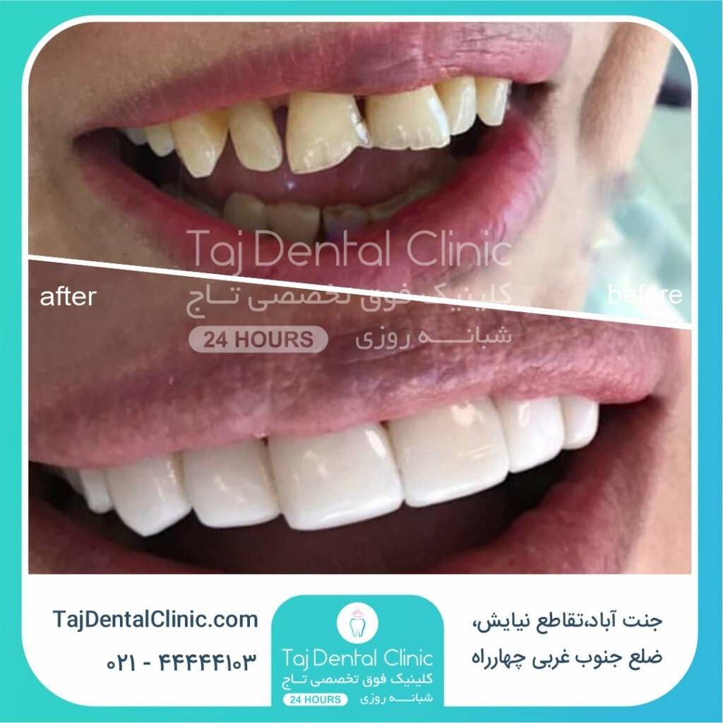 عکس قبل و بعد کامپوزیت دندان در کلینیک تاج با هزینه مناسب
