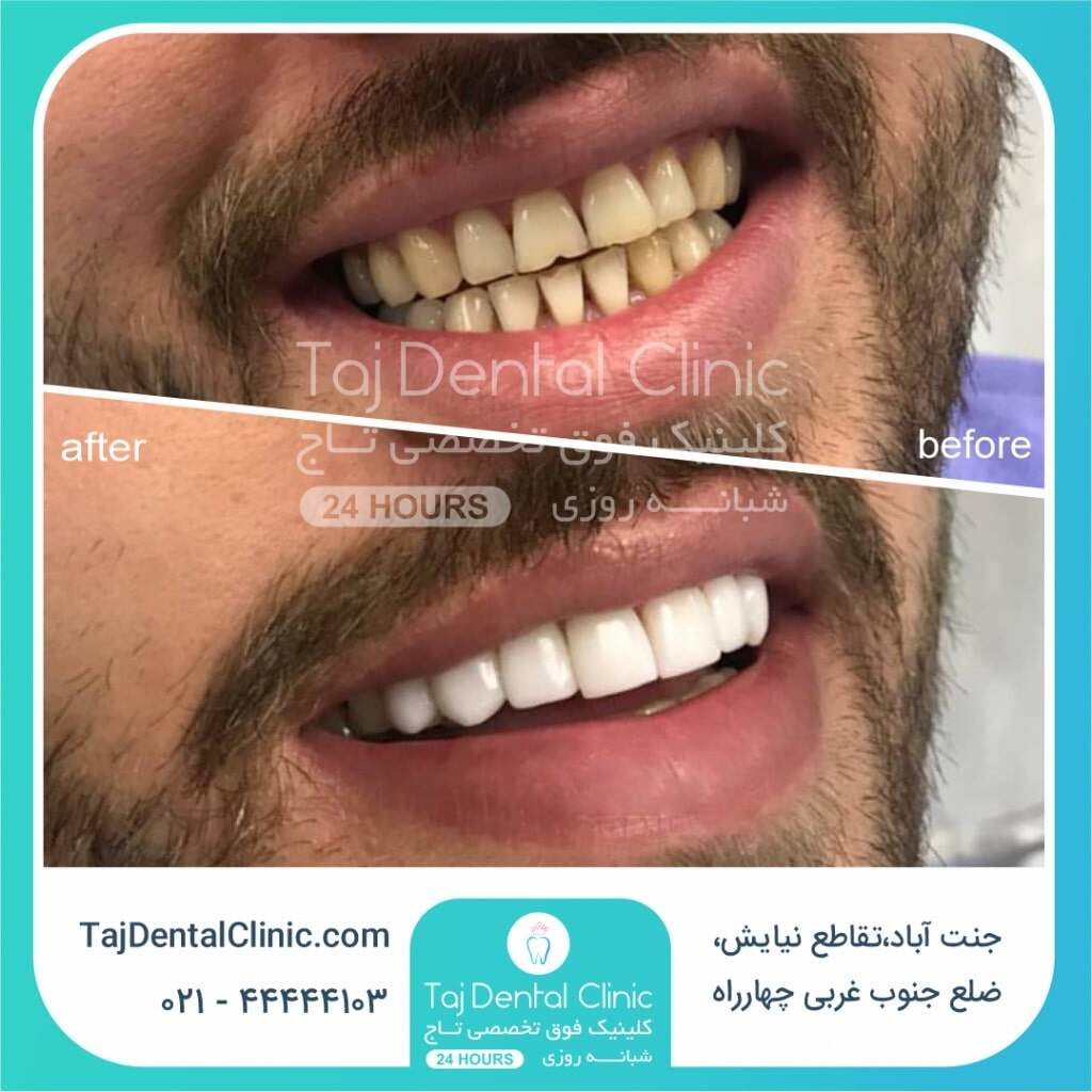 عکس قبل و بعد کامپوزیت ونیر دندان در کلینیک تاج
