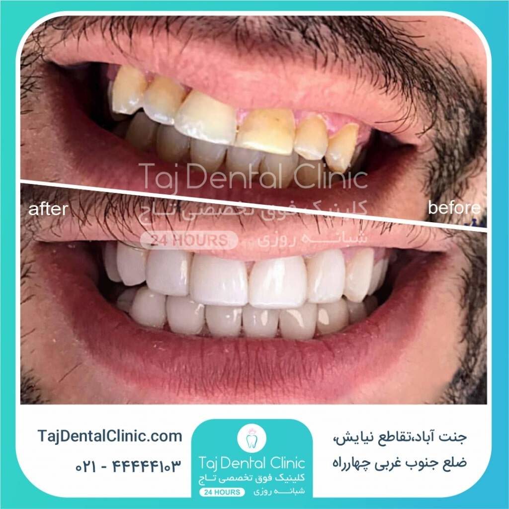 عکس قبل و بعد کامپوزیت دندان در کلینیک تاج