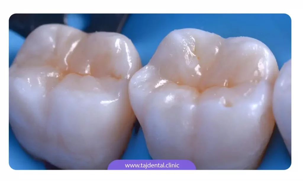 عکس بیلداپ دندان با کامپوزیت دندان