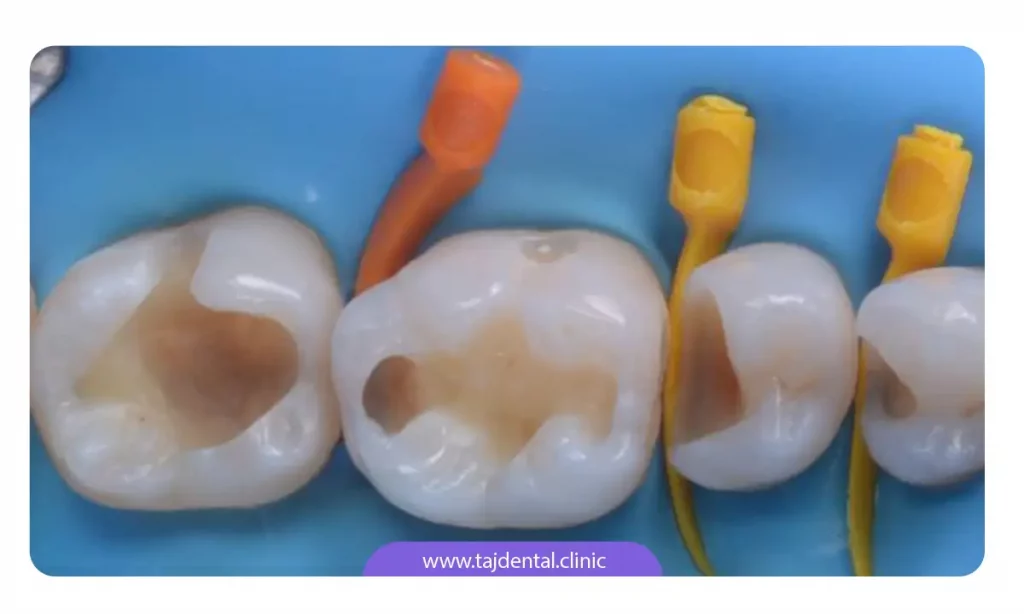 عکس پر کردن دندان با کامپوزیت دندان