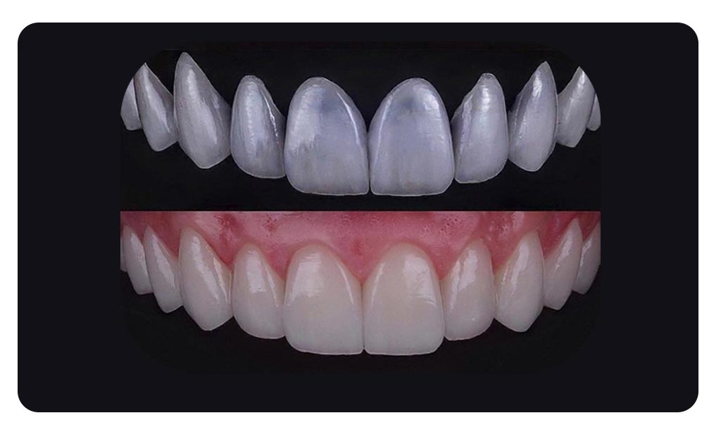 عکس لمینت دندان زیرکونیا برای قوس فکی بالا