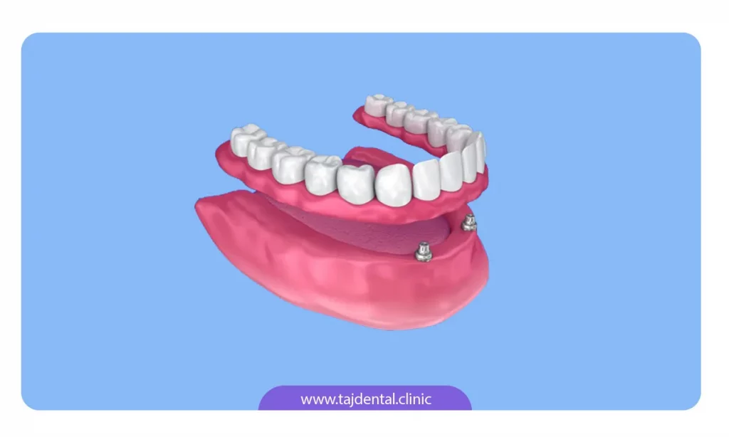 عکس دندان مصنوعی ثابت متکی بر ایمپلنت