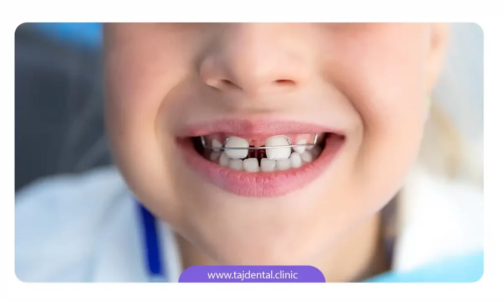 عکس کودکی که برای بستن فاصله بین دندان ها ارتودنسی انجام داده است
