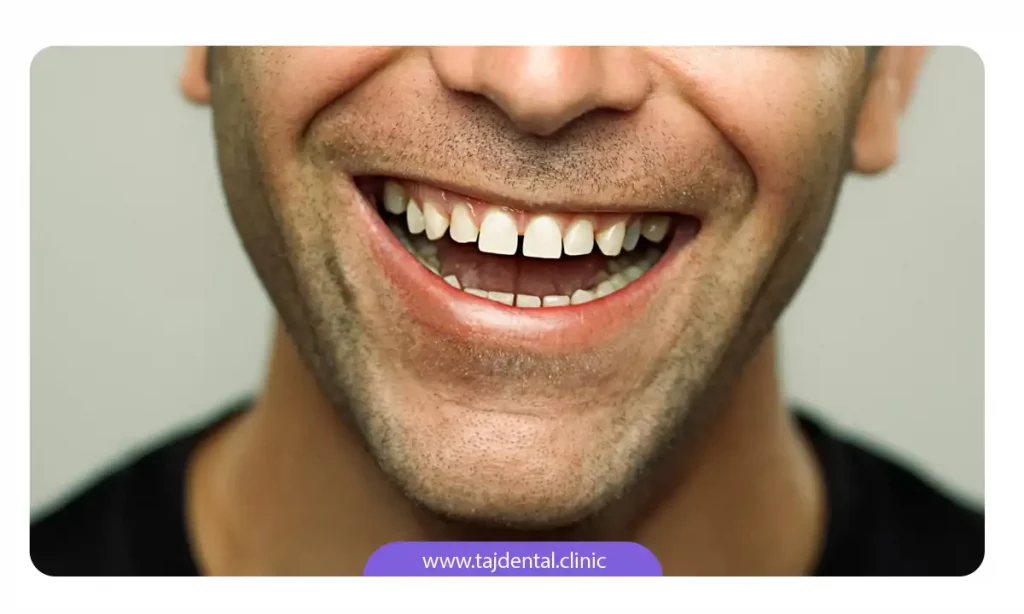 مردی که با فاصله بین دندان های جلو و سایر دندان ها مواجه است