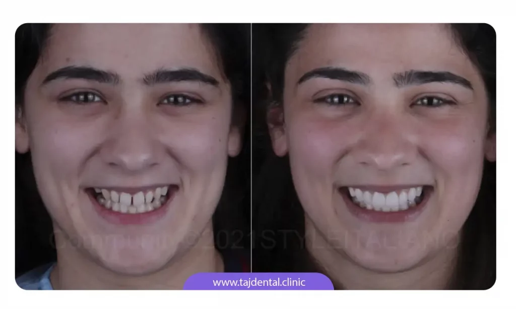 عکس قبل و بعد دختری که فاصل بین دندان های جلوی خود را با لمینت بسته است.