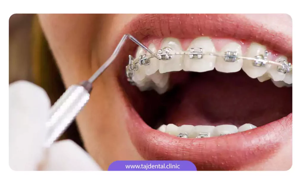 متخصص ارتودنسی در حال اتصال براکت ها به سطح دندان با کمک کامپوزیت دندان است
