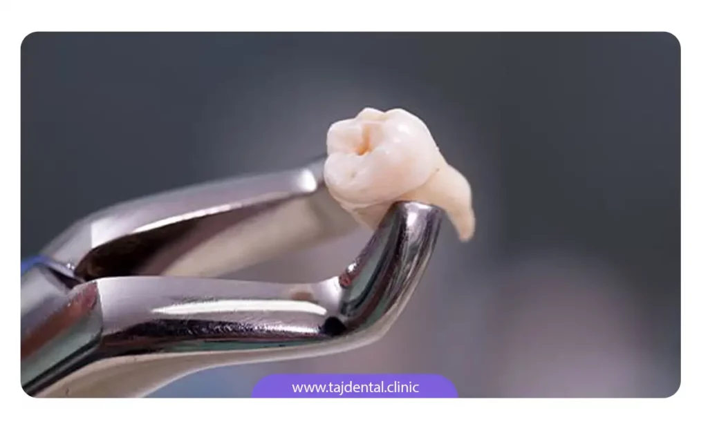 عکسی یک دندان عقل کشیده شده توسط جراح دهان و دندان