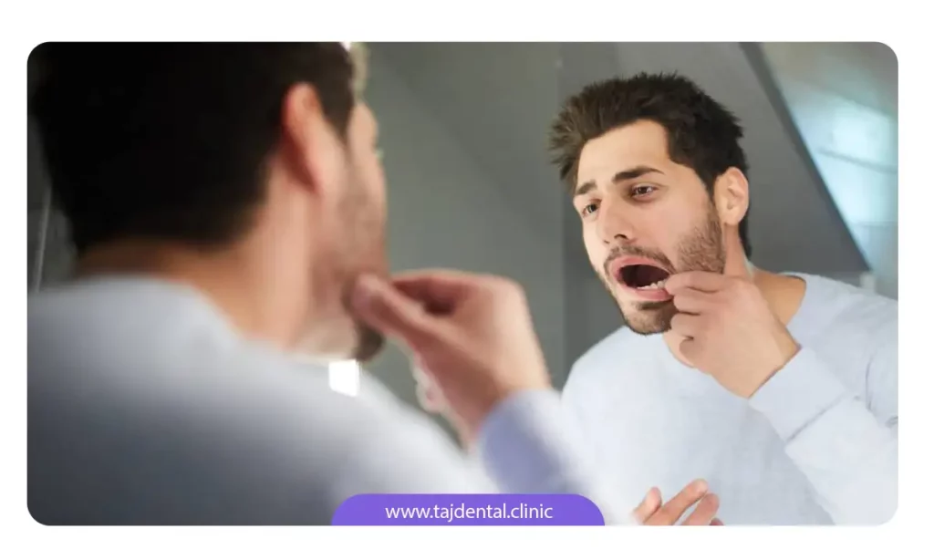 پوسیدگی دندان در یک مرد جوان که باعث بوی بد دهان شده
