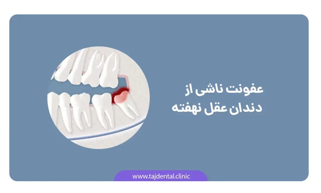 عکش شماتیک عوارض دندان عقل نهفته : عفونت