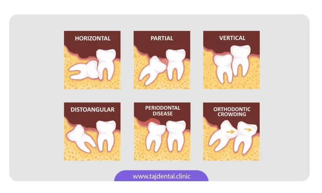 عکس شکل های مختلف نهفتگی دندان