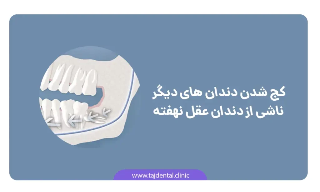 عکش شماتیک عوارض دندان عقل نهفته : وارد کردن فشار به سایر دندان ها
