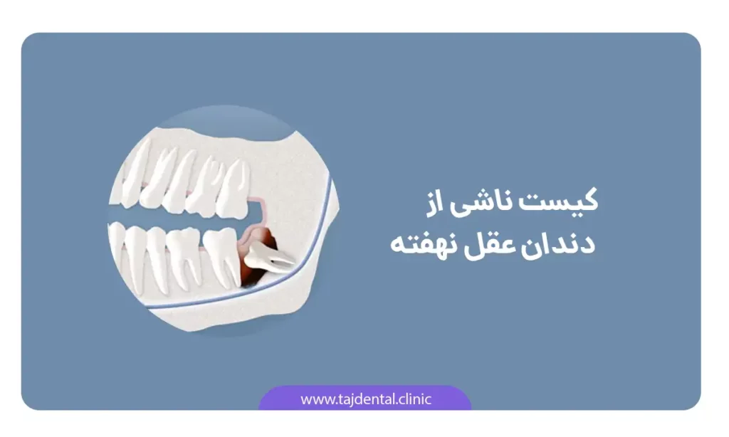 عکش شماتیک عوارض دندان عقل نهفته : کیست