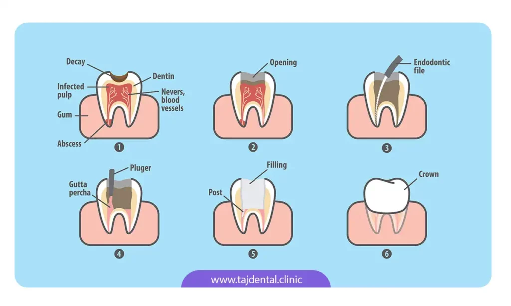 مراحل و فرآیند عصب کشی دندان