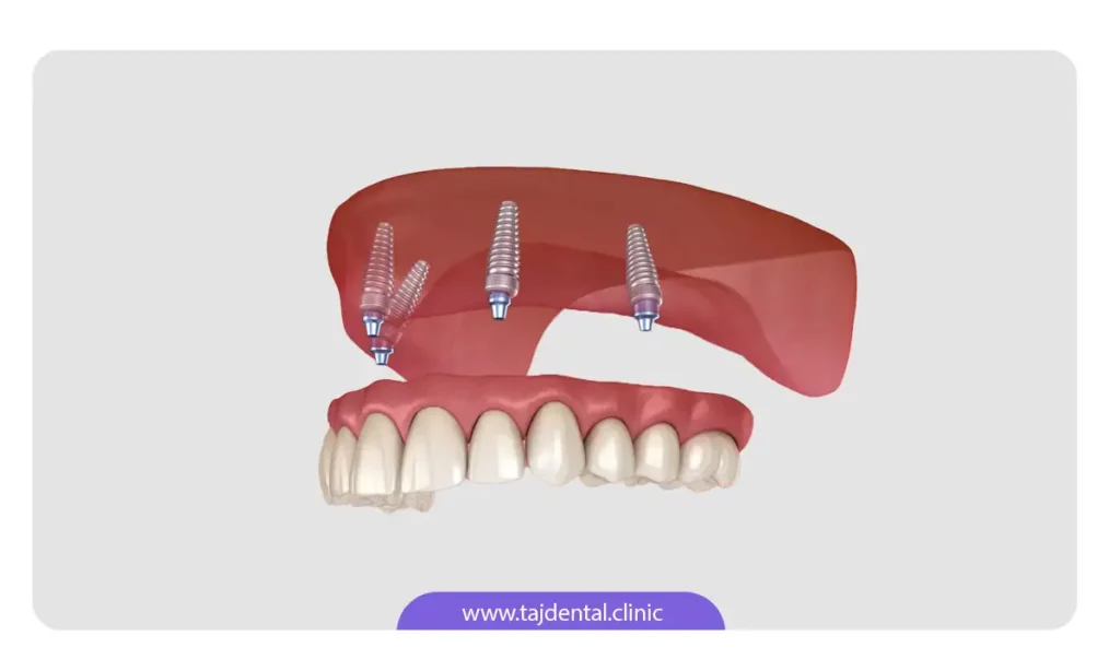 تصویر شماتیم دندان مصنوعی ثابت بر پایه ایمپلنت