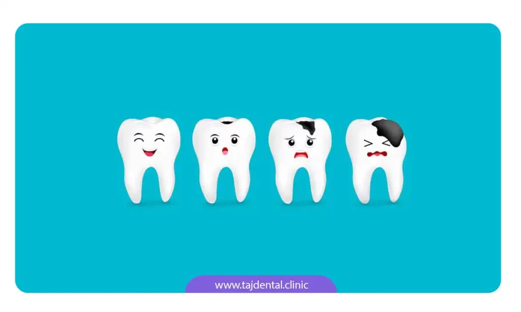 فلرایدتراپی و پیشگیری از پوسیدگی دندان ها