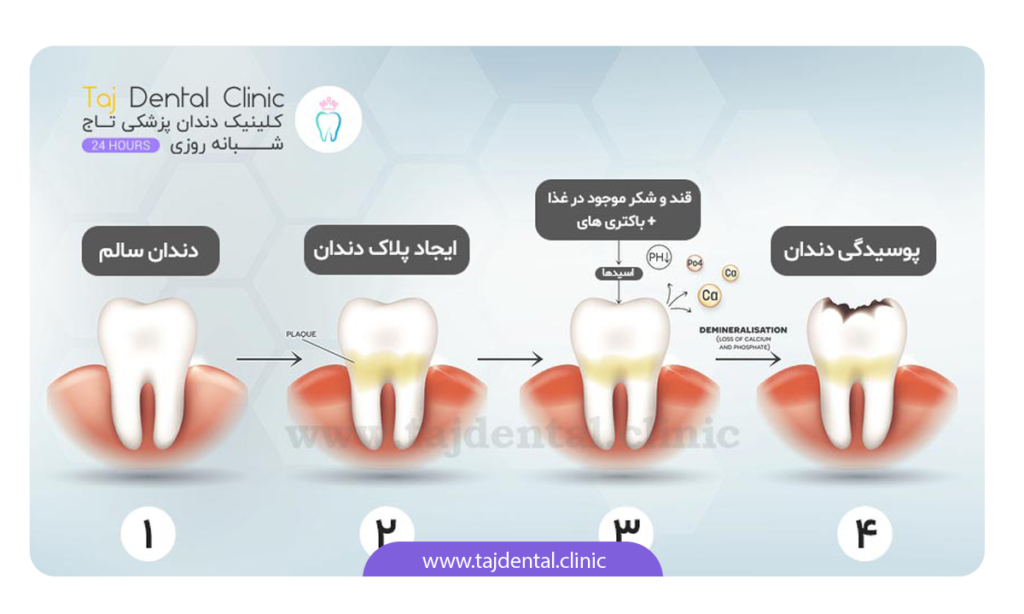 مراحل تشکیل پلاک دندان