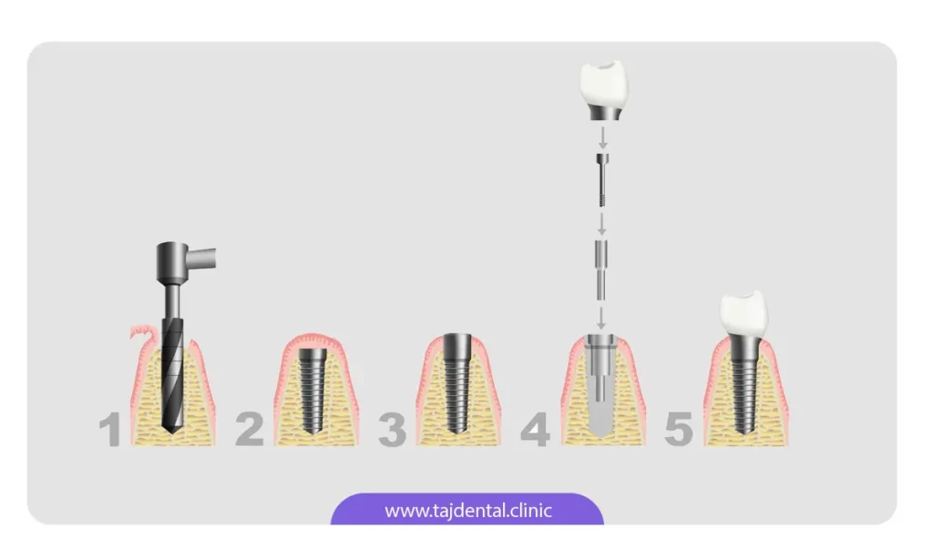 تصویر مراحل کاشت ایمپلنت دندان