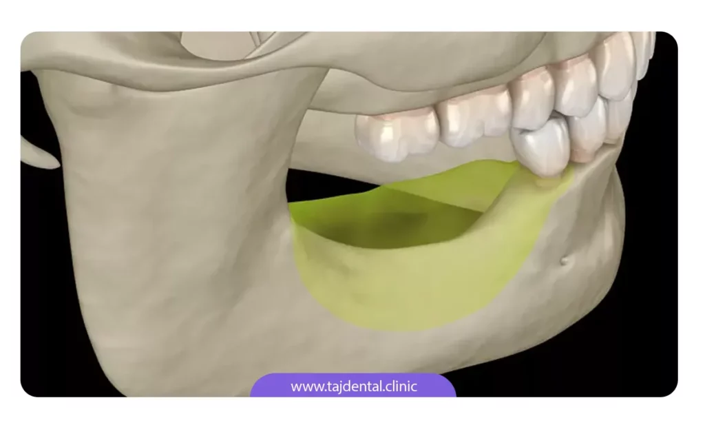 تصویر شماتیک از جای خالی دندان 