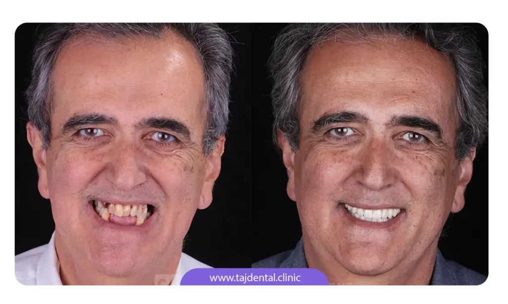 عکس قبل و بعد از کاشت ایمپلنت فوری دندان