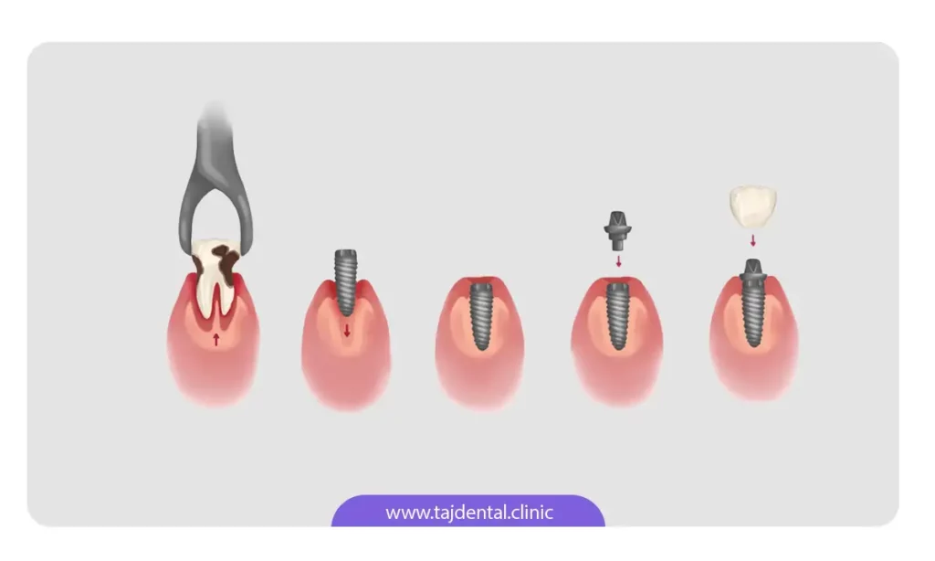 مراحل شماتیک کاشت ایمپلنت فوری دندان