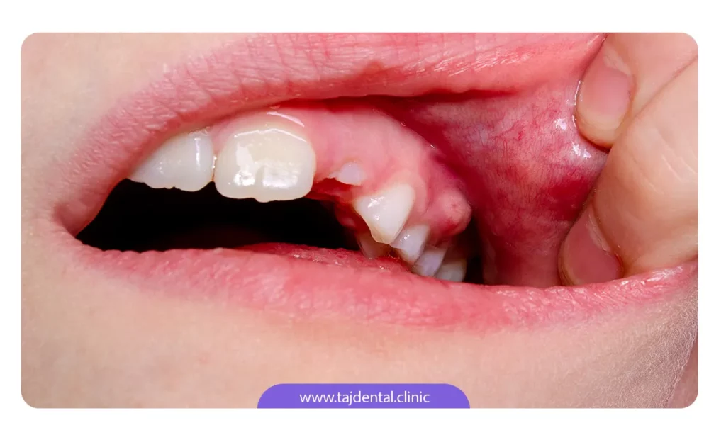 عکس ابسه دندان به عنوان یک بیماری لثه