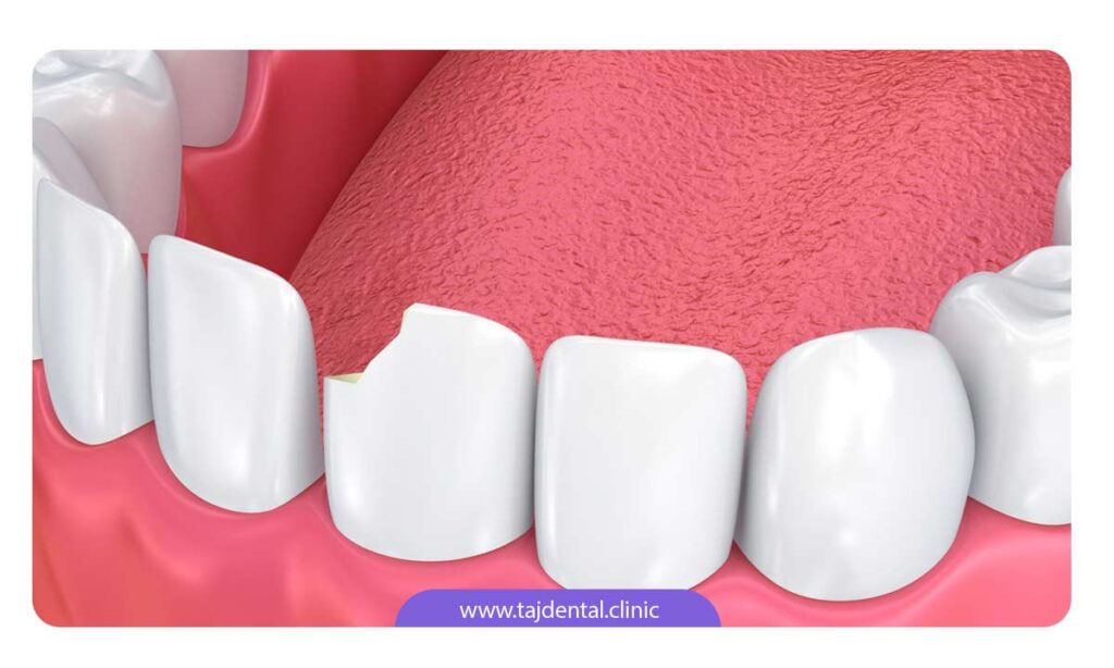 روش های درمان حساسیت دندان کودک