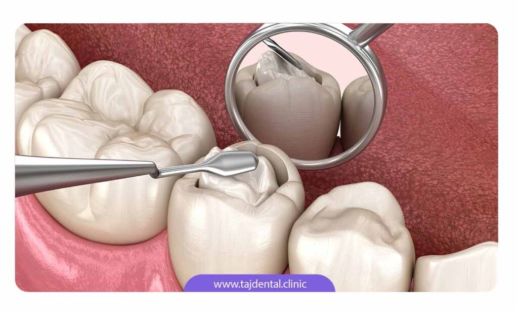 پر کردن دندان با مواد مختلف