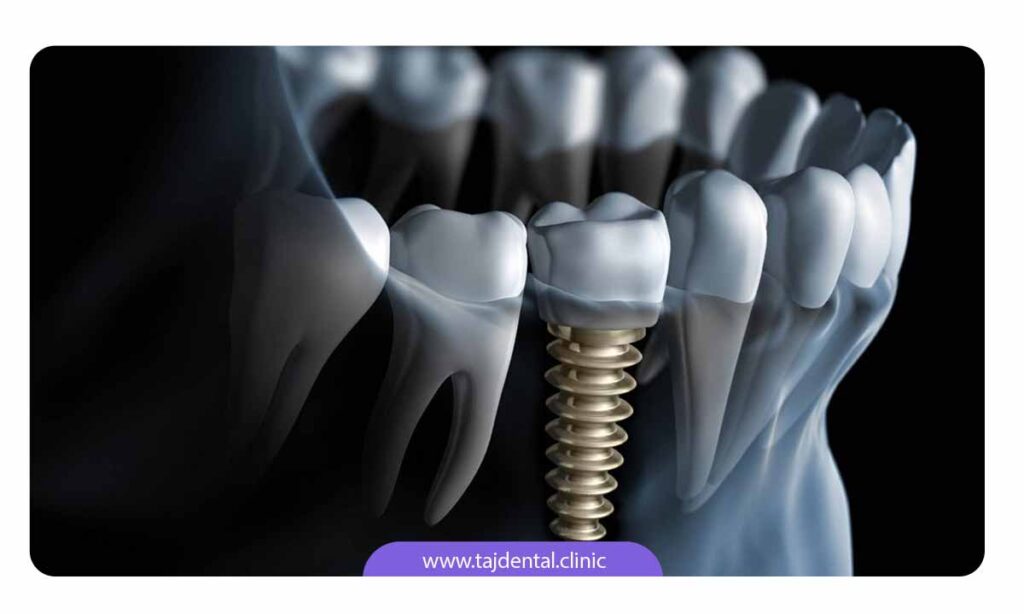 مراحل ایمپلنت دندان عقب