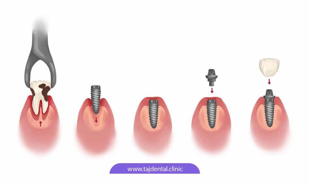 مراحل ایمپلنت دندان آسیاب