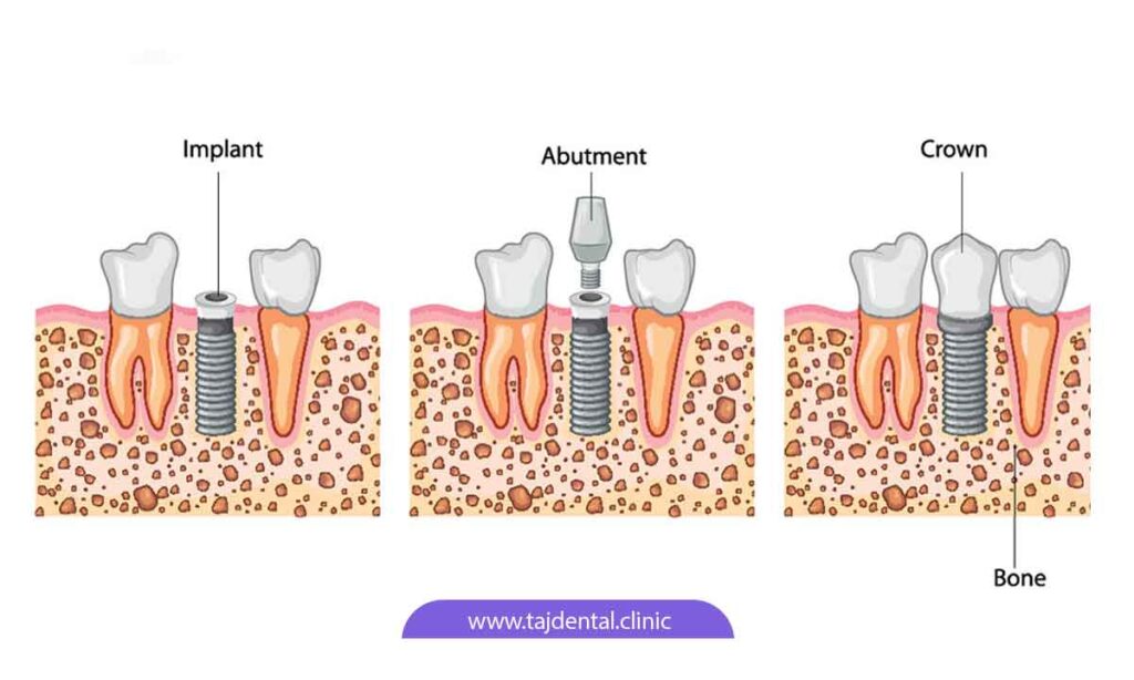 مراحل ایمپلنت دندان فک بالا