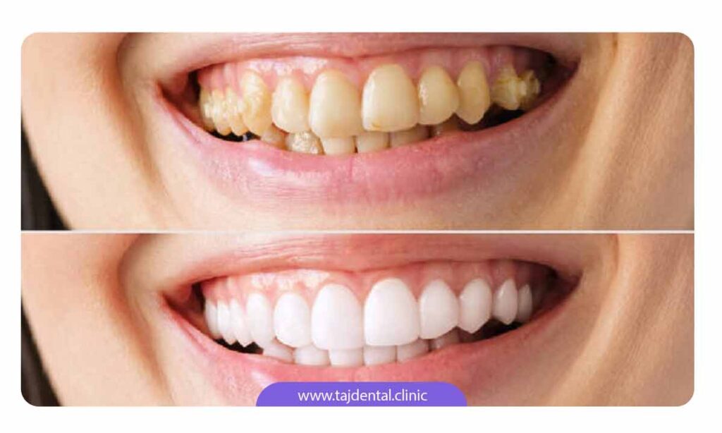 بعد از بلیچینگ دندان چه مراقبت هایی لازم است؟