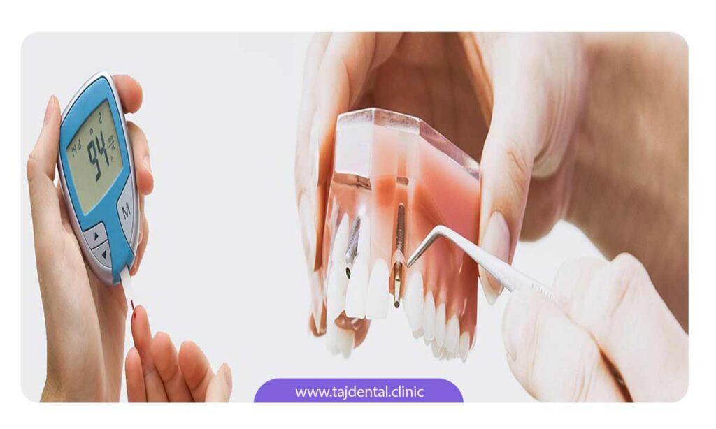 کاشت ایمپلنت دندان در بیماران دیابتی