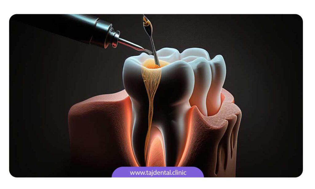 درد درمان ریشه یا عصب کشی دندان 