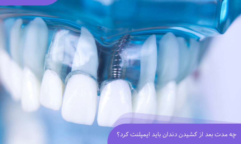 چه مدت بعد از کشیدن دندان باید ایمپلنت کرد؟