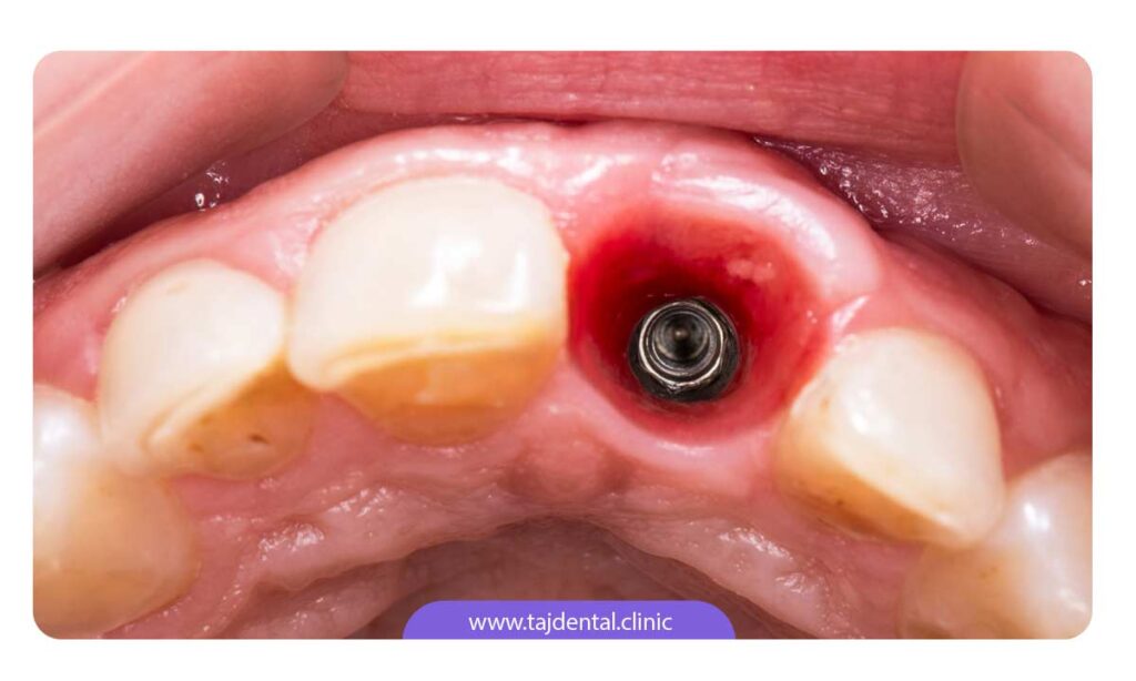 تصویر پیچ ایمپلنت در داخل لثه دندان جلو