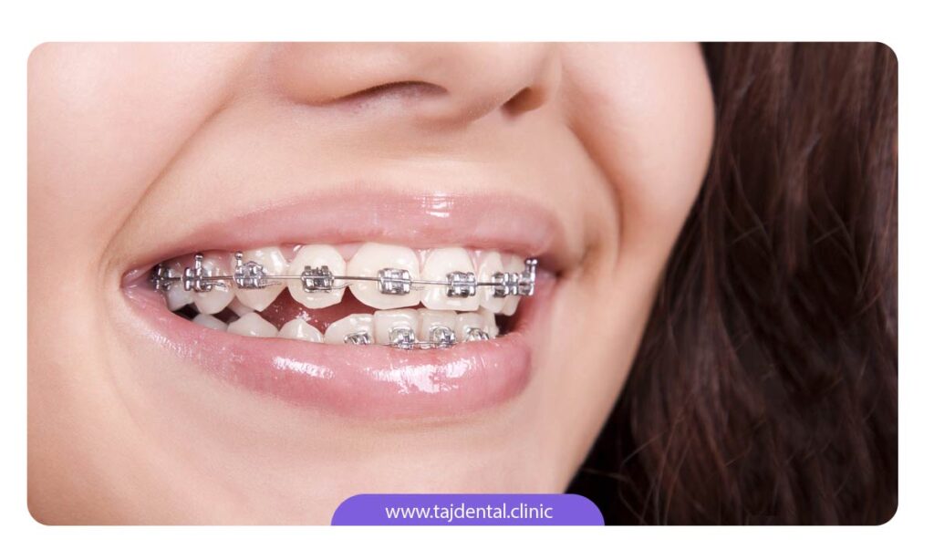 تصویر دختری که دندان های خود را ارتودنسی ثابت کرده است