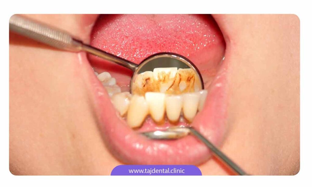 تصویر جرم روی دندان ها