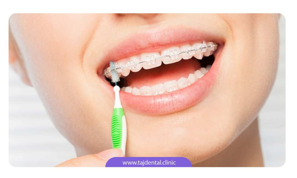 تصویر کسی که در حال تمیز کردن دندان ها با مسواک ارتودنسی است