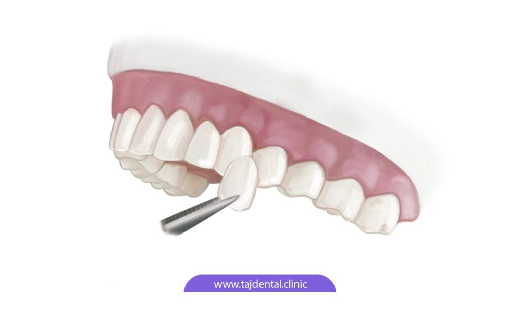تصویر شماتیک نصب لمینت دندان