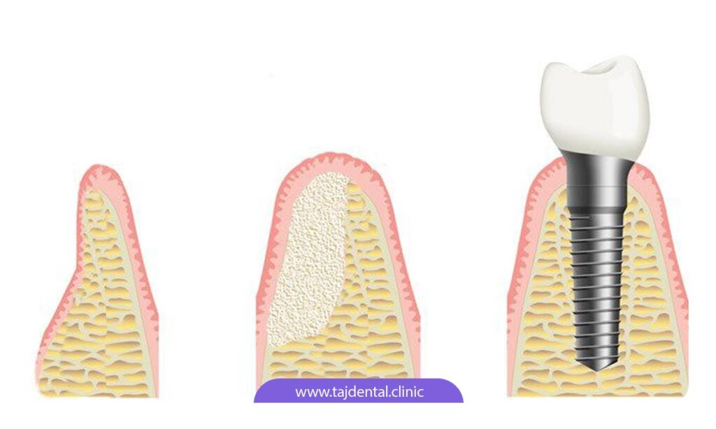 تصویر شماتیک پیوند استخوان برای ایمپلنت دندان